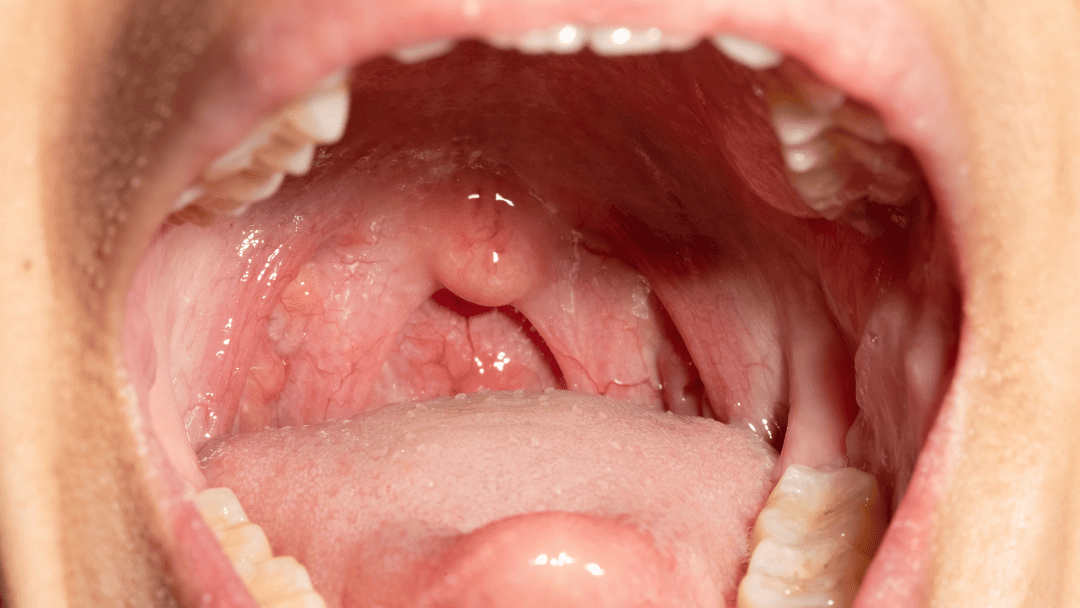 大きく開かれた口